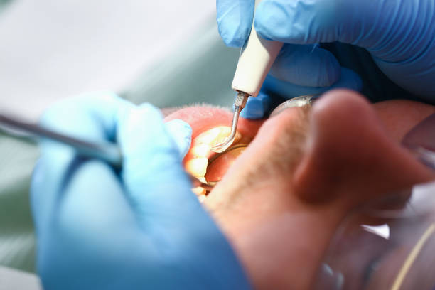 Best Emergency Dentist for Lost Fillings or Crowns in Larch Y, WA